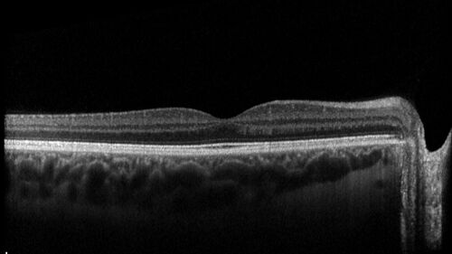 27 year old with migraine - normal imaging
