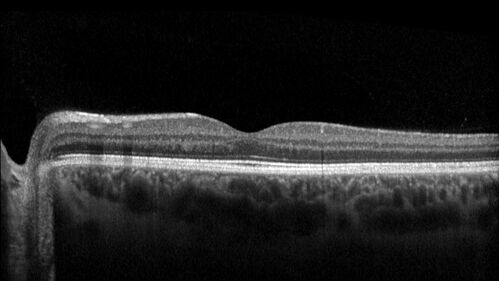 27 year old with migraine - normal imaging
