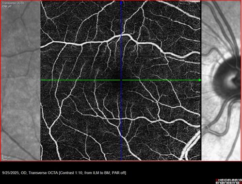 27 year old with migraine - normal imaging
