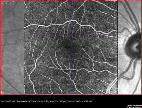 27 year old with migraine - normal imaging
