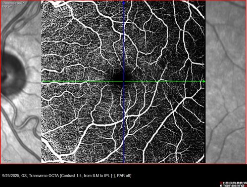 27 year old with migraine - normal imaging

