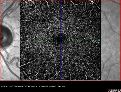 27 year old with migraine - normal imaging
