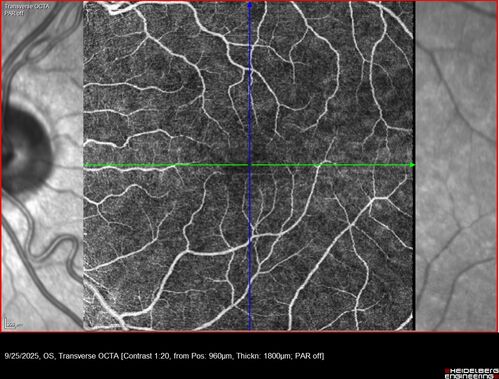 27 year old with migraine - normal imaging
