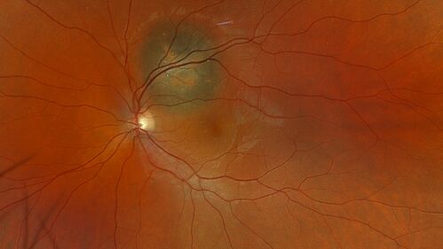 Small choroidal melanoma
28 year old man  Serial images suggested that the lesion is growing
OD: sc20/16 
OS: sc20/40+2 
IOP: TP: OD:19 OS:16 

