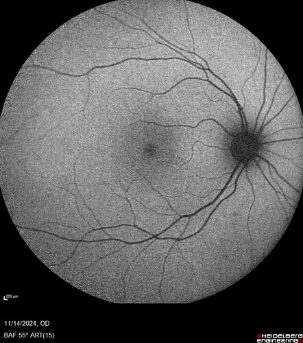 Small choroidal melanoma
28 year old man  Serial images suggested that the lesion is growing
OD: sc20/16 
OS: sc20/40+2 
IOP: TP: OD:19 OS:16 
