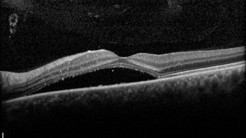 Small choroidal melanoma
28 year old man  Serial images suggested that the lesion is growing
OD: sc20/16 
OS: sc20/40+2 
IOP: TP: OD:19 OS:16 
