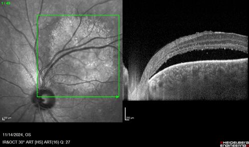 Small choroidal melanoma
28 year old man  Serial images suggested that the lesion is growing
OD: sc20/16 
OS: sc20/40+2 
IOP: TP: OD:19 OS:16 
