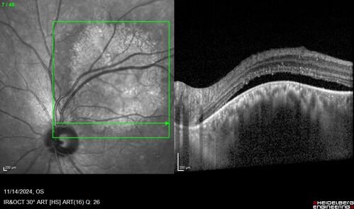 Small choroidal melanoma
28 year old man  Serial images suggested that the lesion is growing
OD: sc20/16 
OS: sc20/40+2 
IOP: TP: OD:19 OS:16 
