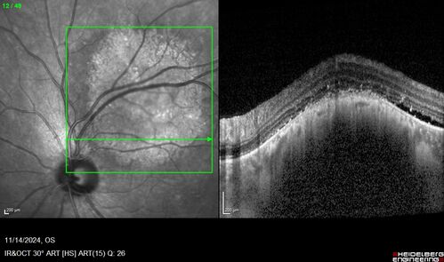 Small choroidal melanoma
28 year old man  Serial images suggested that the lesion is growing
OD: sc20/16 
OS: sc20/40+2 
IOP: TP: OD:19 OS:16 
