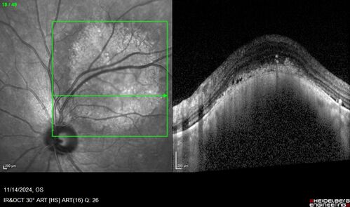 Small choroidal melanoma
28 year old man  Serial images suggested that the lesion is growing
OD: sc20/16 
OS: sc20/40+2 
IOP: TP: OD:19 OS:16 

