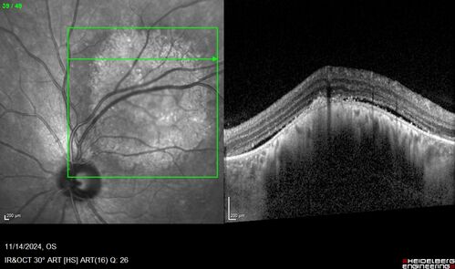 Small choroidal melanoma
28 year old man  Serial images suggested that the lesion is growing
OD: sc20/16 
OS: sc20/40+2 
IOP: TP: OD:19 OS:16 
