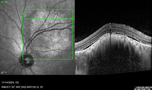 Small choroidal melanoma
28 year old man  Serial images suggested that the lesion is growing
OD: sc20/16 
OS: sc20/40+2 
IOP: TP: OD:19 OS:16 
