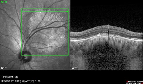 Small choroidal melanoma
28 year old man  Serial images suggested that the lesion is growing
OD: sc20/16 
OS: sc20/40+2 
IOP: TP: OD:19 OS:16 
