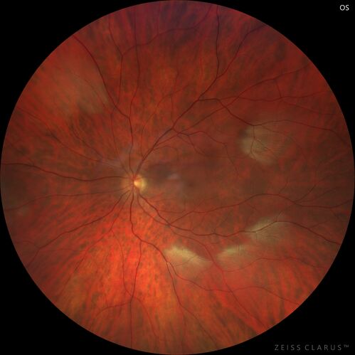 Myelinated Nerve Fiber Layer - Peripheral
43 year old man with floaters
