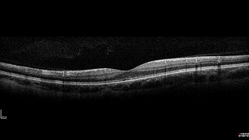 Myelinated Nerve Fiber Layer - Peripheral
43 year old man with floaters
