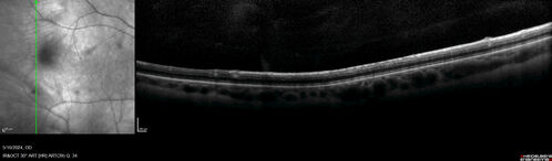 Myelinated Nerve Fiber Layer - Peripheral
43 year old man with floaters
