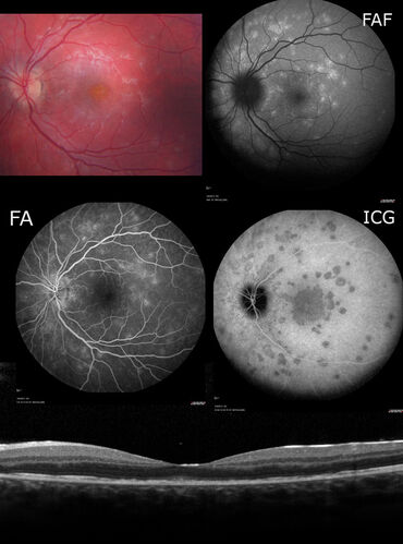 Multiple Evanescent White Dot Syndrome - 13-year-old female
Vision is 20/60 but recovered to 20/20 in about 2 months.  This episode was post viral syndrome
