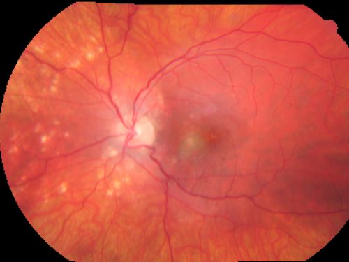 Multifocal Choroiditis and Subretinal Fibrosis - 32 yo Female Montage Initial Visit
32-year-old woman vision loss in the right eye associated with macular scarring and multifocal choroiditis in 1999 with new vision loss in left eye:  OD 20/400, OS 20/50. 

2 months post-rx with posterior subtenons kenalog and intravitreal avastin - va os 20/30 and lesion has retracted and organized.  It never subsequently grew over 2 years follow-up
Keywords: Multifocal Choroiditis;Macular Scar;Fibrosis;Uveitis
