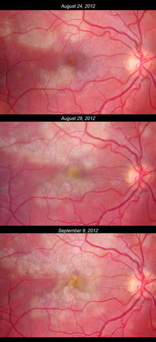 Acute Posterior Multifocal Placoid Pigment Epitheliopathy - APMPPE - Sequential color photos show progression
Vision in right eye dropped to 5/200 by the last photo.
