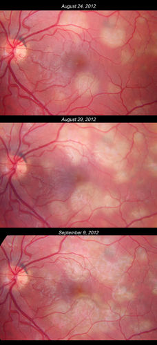 Acute Posterior Multifocal Placoid Pigment Epitheliopathy - APMPPE - Sequential color photos show progression
Vision in right eye dropped to 5/200 by the last photo.
