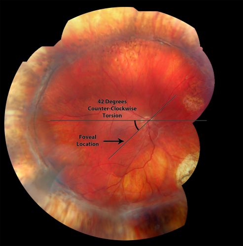 Retinal Torsion after Macula Off Retinal Detachment Repair with Inferior PVR
37 year old with torsion of the retina after macula off retinal detachment repair with inferior PVR and membranes dragging the fovea inferiorly.
