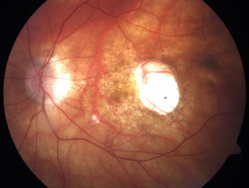 Myopic Traction Maculopathy - Long Term Follow-up
88-92 year old woman with about 20/40 vision and myopic tractional maculopathy.  Her vision fluctuates a little.  The serial OCT's show no progression.
