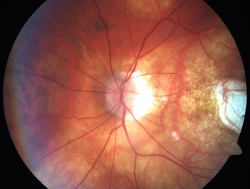 Myopic Traction Maculopathy - Long Term Follow-up
88-92 year old woman with about 20/40 vision and myopic tractional maculopathy.  Her vision fluctuates a little.  The serial OCT's show no progression.
