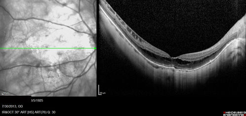Myopic Traction Maculopathy - Long Term Follow-up
88-92 year old woman with about 20/40 vision and myopic tractional maculopathy.  Her vision fluctuates a little.  The serial OCT's show no progression.
