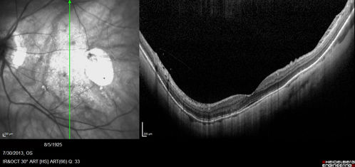 Myopic Traction Maculopathy - Long Term Follow-up
88-92 year old woman with about 20/40 vision and myopic tractional maculopathy.  Her vision fluctuates a little.  The serial OCT's show no progression.
