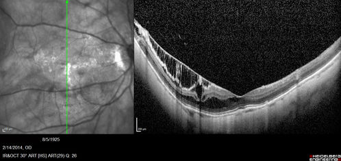 Myopic Traction Maculopathy - Long Term Follow-up
88-92 year old woman with about 20/40 vision and myopic tractional maculopathy.  Her vision fluctuates a little.  The serial OCT's show no progression.
