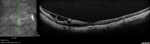 Myopic Traction Maculopathy - Long Term Follow-up
88-92 year old woman with about 20/40 vision and myopic tractional maculopathy.  Her vision fluctuates a little.  The serial OCT's show no progression.
