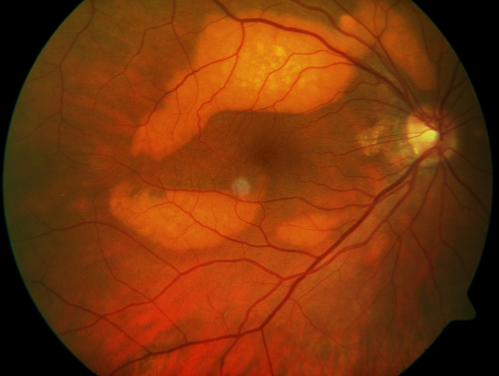 Multifocal Vitelliform Macular Dystrophy
58 year old female with mild vision loss - 20/20 OU - extensive testing has shown no cancer.  Case of Karina Findlay, MD
Keywords: Karina Findlay