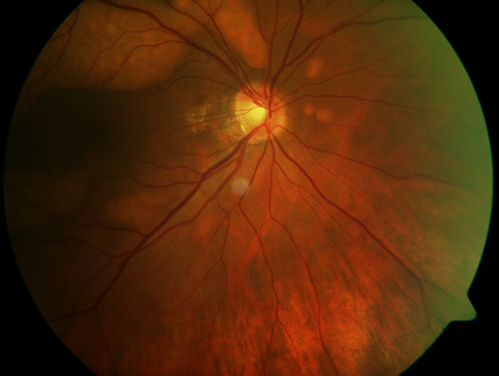 Multifocal Vitelliform Macular Dystrophy
58 year old female with mild vision loss - 20/20 OU - extensive testing has shown no cancer.  Case of Karina Findlay, MD
Keywords: Karina Findlay