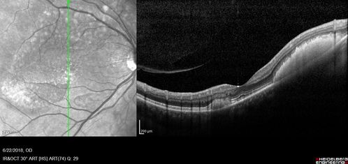 Multifocal Vitelliform Macular Dystrophy
58 year old female with mild vision loss - 20/20 OU - extensive testing has shown no cancer.  Case of Karina Findlay, MD
Keywords: Karina Findlay