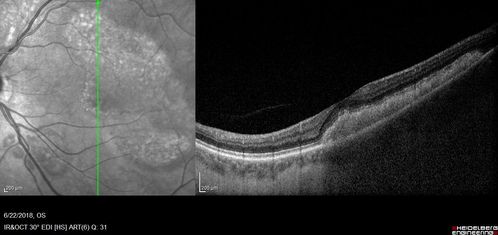 Multifocal Vitelliform Macular Dystrophy
58 year old female with mild vision loss - 20/20 OU - extensive testing has shown no cancer.  Case of Karina Findlay, MD
Schlüsselwörter: Karina Findlay