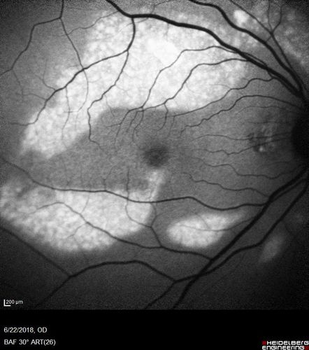 Multifocal Vitelliform Macular Dystrophy
58 year old female with mild vision loss - 20/20 OU - extensive testing has shown no cancer.  Case of Karina Findlay, MD
Keywords: Karina Findlay