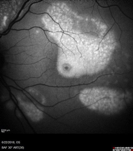 Multifocal Vitelliform Macular Dystrophy
58 year old female with mild vision loss - 20/20 OU - extensive testing has shown no cancer.  Case of Karina Findlay, MD
Võtmesõnad: Karina Findlay