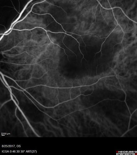 Multifocal Vitelliform Macular Dystrophy
58 year old female with mild vision loss - 20/20 OU - extensive testing has shown no cancer.  Case of Karina Findlay, MD
Keywords: Karina Findlay