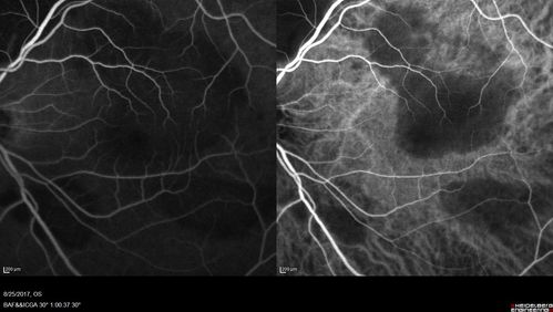 Multifocal Vitelliform Macular Dystrophy
58 year old female with mild vision loss - 20/20 OU - extensive testing has shown no cancer.  Case of Karina Findlay, MD
Keywords: Karina Findlay