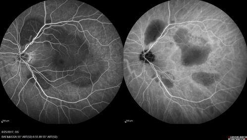 Multifocal Vitelliform Macular Dystrophy
58 year old female with mild vision loss - 20/20 OU - extensive testing has shown no cancer.  Case of Karina Findlay, MD
Keywords: Karina Findlay