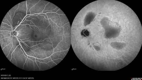 Multifocal Vitelliform Macular Dystrophy
58 year old female with mild vision loss - 20/20 OU - extensive testing has shown no cancer.  Case of Karina Findlay, MD
Keywords: Karina Findlay