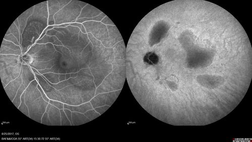 Multifocal Vitelliform Macular Dystrophy
58 year old female with mild vision loss - 20/20 OU - extensive testing has shown no cancer.  Case of Karina Findlay, MD
Keywords: Karina Findlay