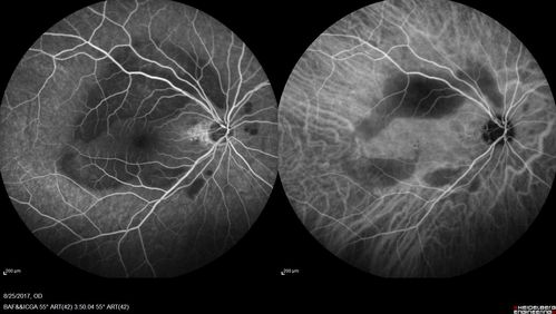 Multifocal Vitelliform Macular Dystrophy
58 year old female with mild vision loss - 20/20 OU - extensive testing has shown no cancer.  Case of Karina Findlay, MD
Keywords: Karina Findlay