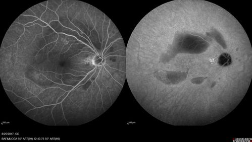 Multifocal Vitelliform Macular Dystrophy
58 year old female with mild vision loss - 20/20 OU - extensive testing has shown no cancer.  Case of Karina Findlay, MD
Keywords: Karina Findlay