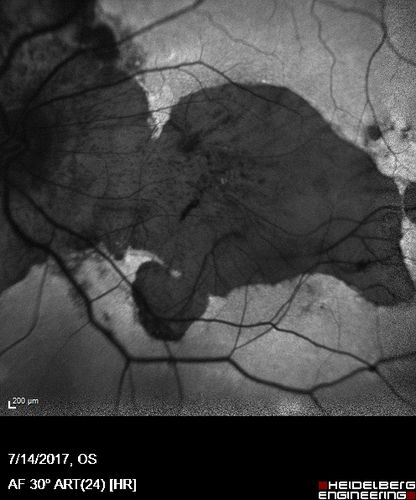 Rapid macular atrophy with anti-VEGF therapy for myopic CNVM
64 year old female with 20/32 vision and distortion in the left and better eye.  She was treated with monthly lucentis and her vision declined to 20/100.  Medicine was stopped and she improved a little to 20/80.
