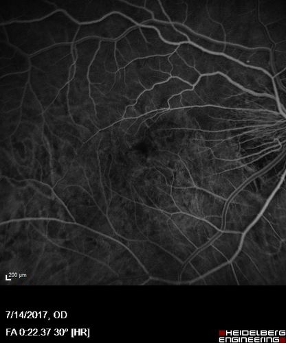Rapid macular atrophy with anti-VEGF therapy for myopic CNVM
64 year old female with 20/32 vision and distortion in the left and better eye.  She was treated with monthly lucentis and her vision declined to 20/100.  Medicine was stopped and she improved a little to 20/80.
