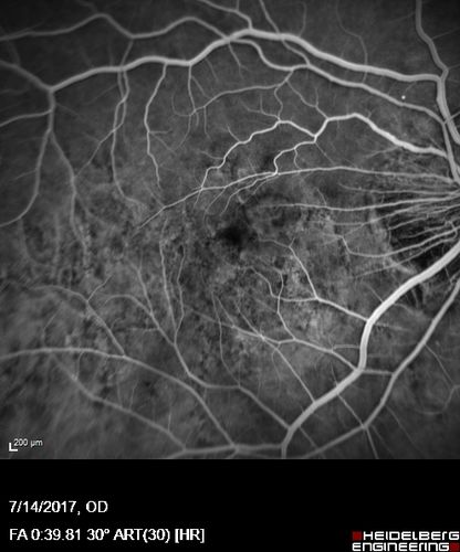 Rapid macular atrophy with anti-VEGF therapy for myopic CNVM
64 year old female with 20/32 vision and distortion in the left and better eye.  She was treated with monthly lucentis and her vision declined to 20/100.  Medicine was stopped and she improved a little to 20/80.
