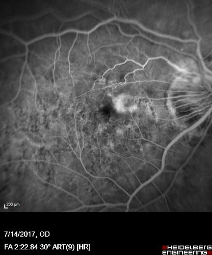 Rapid macular atrophy with anti-VEGF therapy for myopic CNVM
64 year old female with 20/32 vision and distortion in the left and better eye.  She was treated with monthly lucentis and her vision declined to 20/100.  Medicine was stopped and she improved a little to 20/80.
