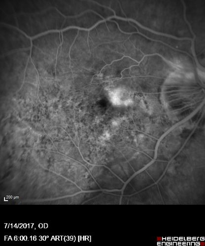 Rapid macular atrophy with anti-VEGF therapy for myopic CNVM
64 year old female with 20/32 vision and distortion in the left and better eye.  She was treated with monthly lucentis and her vision declined to 20/100.  Medicine was stopped and she improved a little to 20/80.
