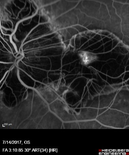 Rapid macular atrophy with anti-VEGF therapy for myopic CNVM
64 year old female with 20/32 vision and distortion in the left and better eye.  She was treated with monthly lucentis and her vision declined to 20/100.  Medicine was stopped and she improved a little to 20/80.
